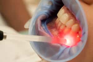 laser gum treatment